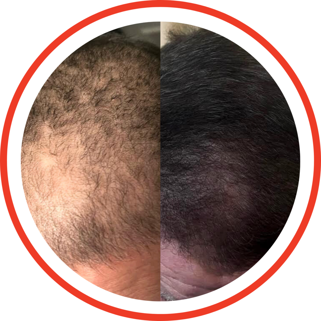 Advanced Hair Restoration